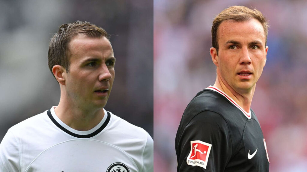 Mario Götze Haartransplantation